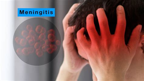 viral meningitis symptoms mayo clinic